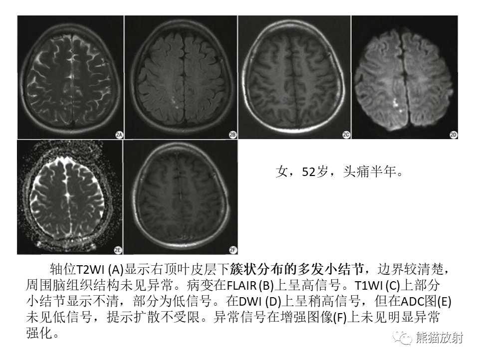 影像PPT - 【PPT】颅内节细胞胶质瘤2例MR影像-48