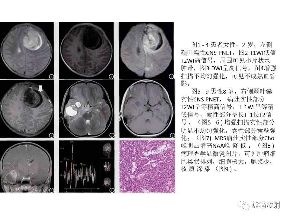 影像PPT - 【PPT】颅内节细胞胶质瘤2例MR影像-46