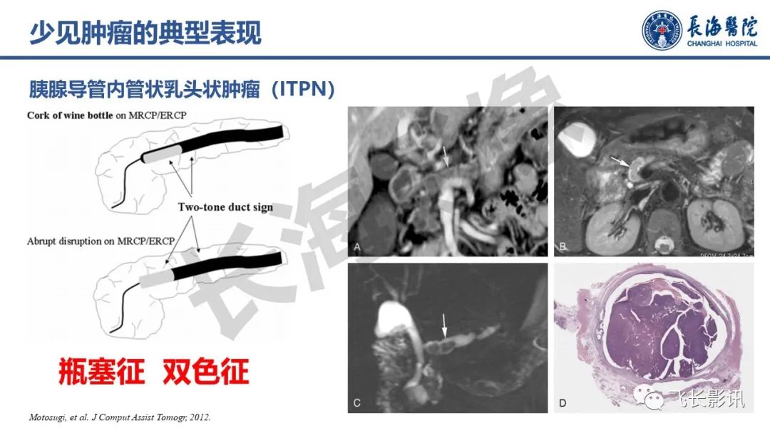 影像PPT - 【PPT】胰腺常见肿瘤的不典型影像表现—实战病例解析-3
