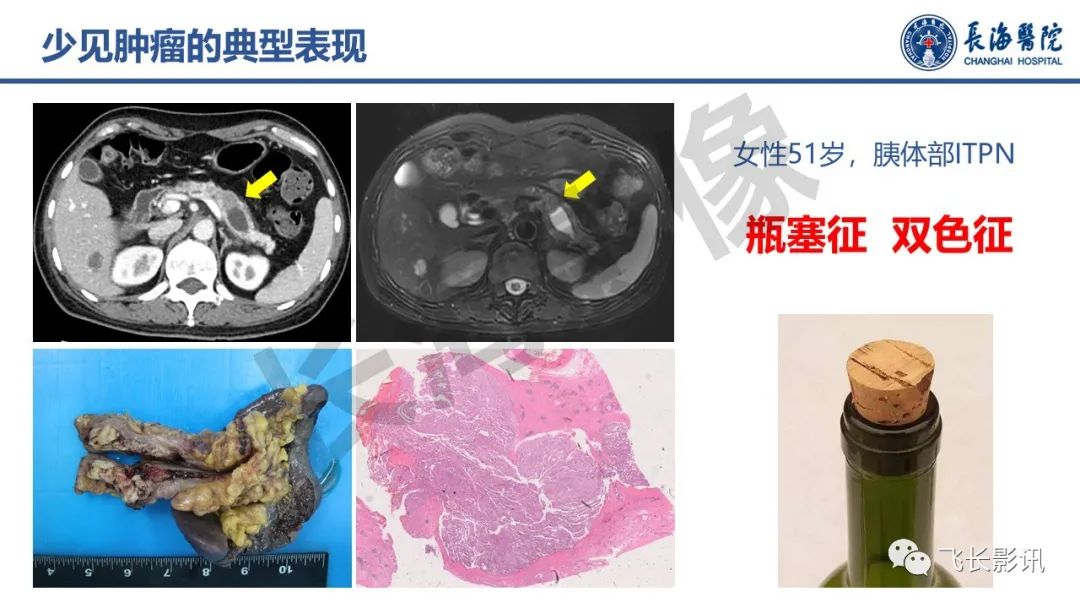 影像PPT - 【PPT】胰腺常见肿瘤的不典型影像表现—实战病例解析-4