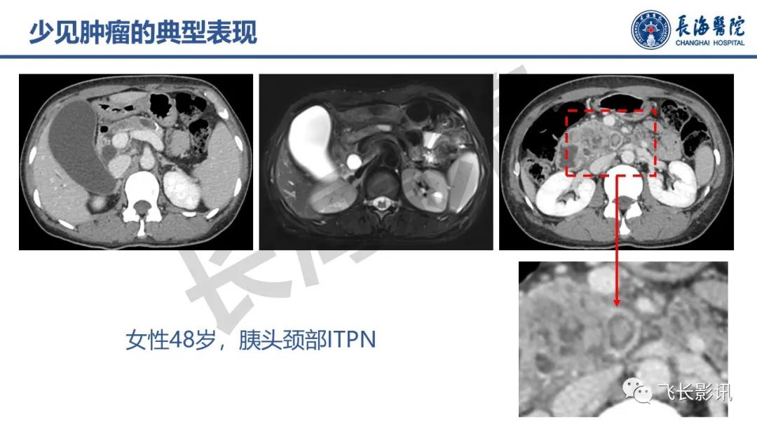 影像PPT - 【PPT】胰腺常见肿瘤的不典型影像表现—实战病例解析-5