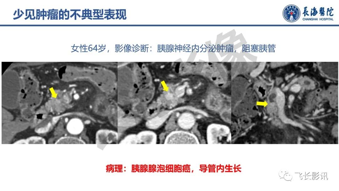 影像PPT - 【PPT】胰腺常见肿瘤的不典型影像表现—实战病例解析-6