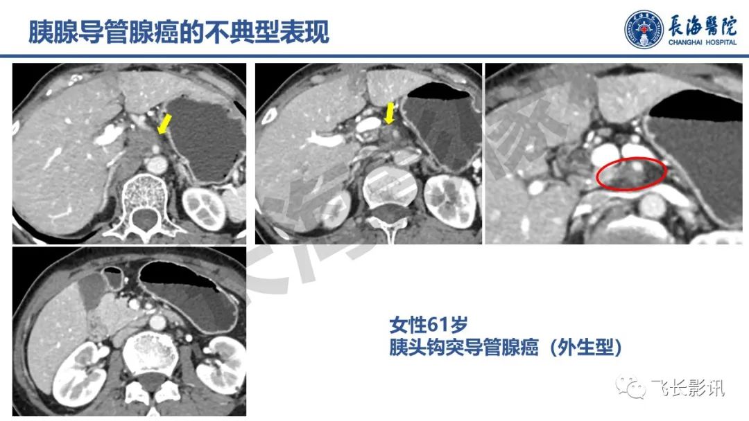 影像PPT - 【PPT】胰腺常见肿瘤的不典型影像表现—实战病例解析-11