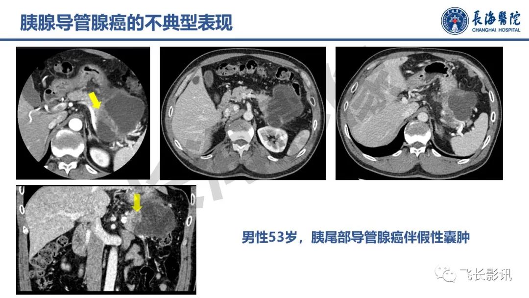 影像PPT - 【PPT】胰腺常见肿瘤的不典型影像表现—实战病例解析-8