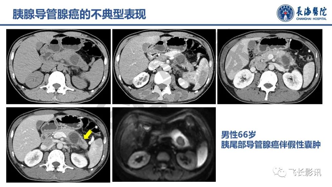 影像PPT - 【PPT】胰腺常见肿瘤的不典型影像表现—实战病例解析-9