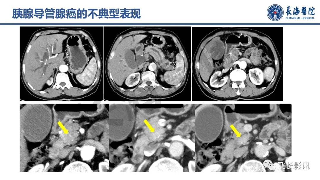 影像PPT - 【PPT】胰腺常见肿瘤的不典型影像表现—实战病例解析-13