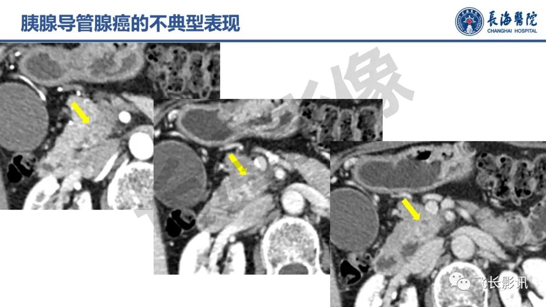 影像PPT - 【PPT】胰腺常见肿瘤的不典型影像表现—实战病例解析-14