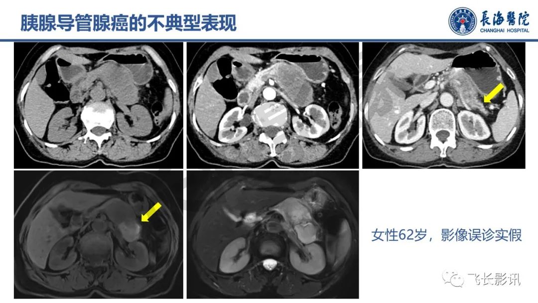 影像PPT - 【PPT】胰腺常见肿瘤的不典型影像表现—实战病例解析-16