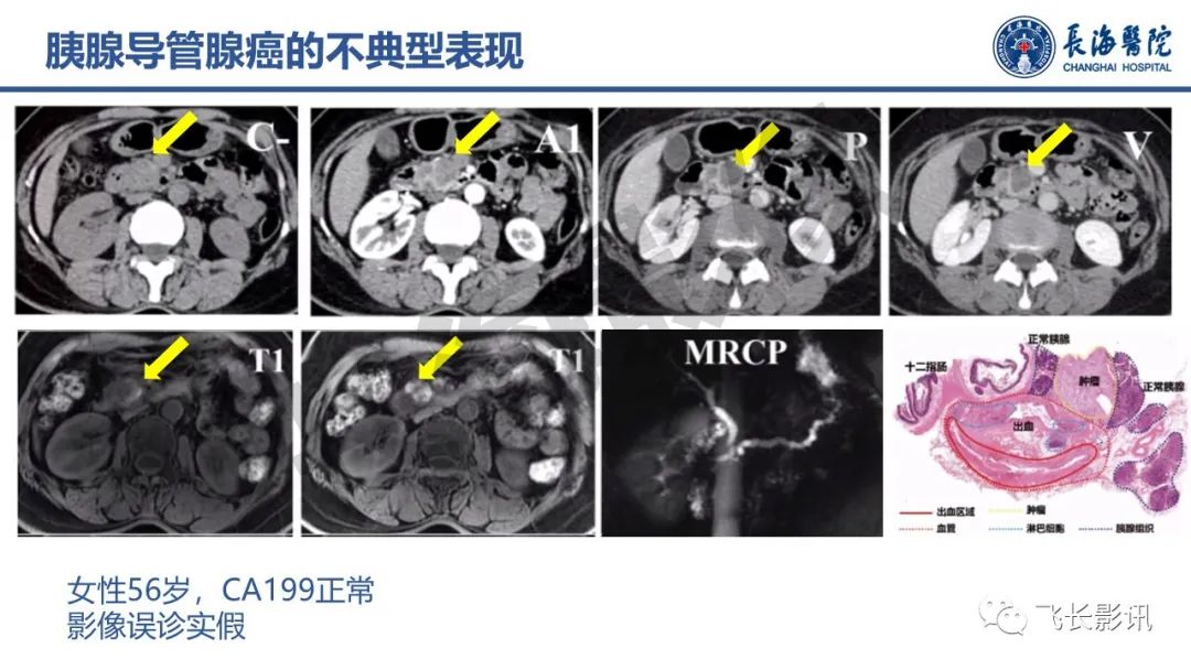 影像PPT - 【PPT】胰腺常见肿瘤的不典型影像表现—实战病例解析-17