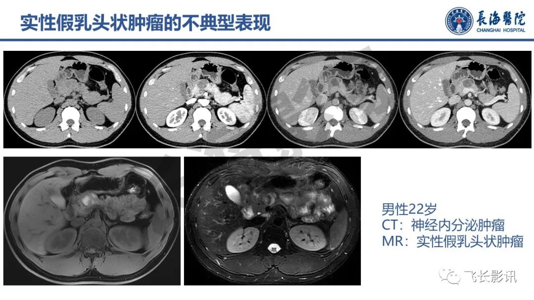 影像PPT - 【PPT】胰腺常见肿瘤的不典型影像表现—实战病例解析-19