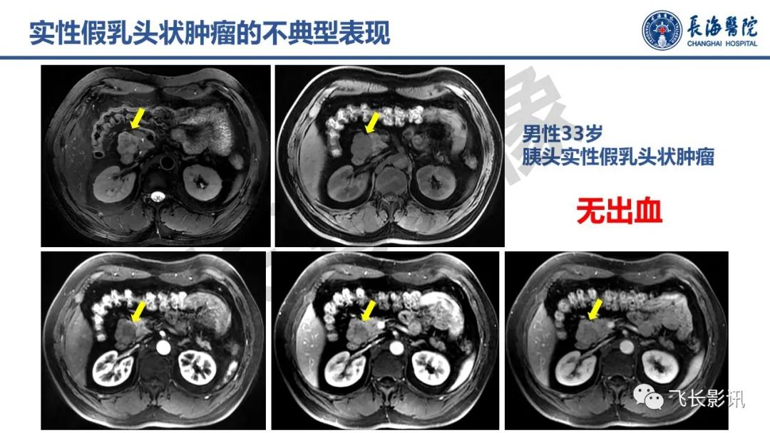 影像PPT - 【PPT】胰腺常见肿瘤的不典型影像表现—实战病例解析-21
