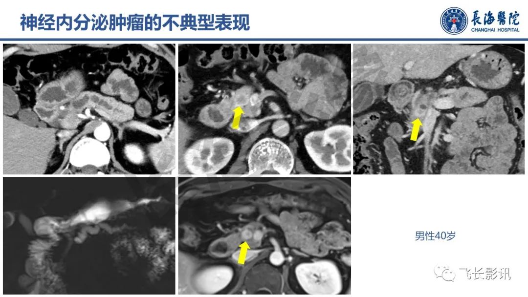 影像PPT - 【PPT】胰腺常见肿瘤的不典型影像表现—实战病例解析-25
