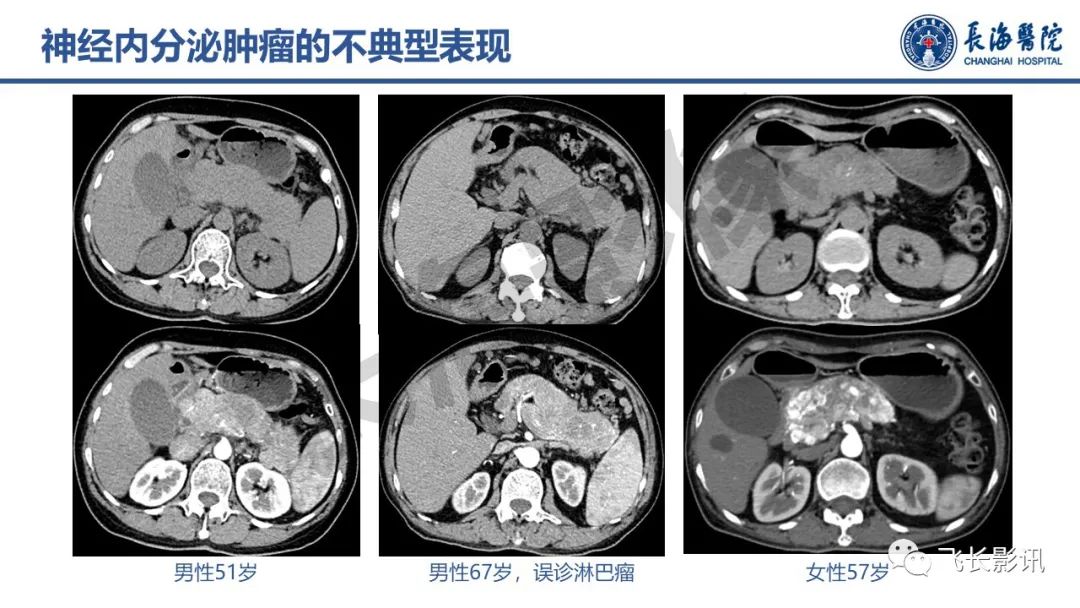 影像PPT - 【PPT】胰腺常见肿瘤的不典型影像表现—实战病例解析-23