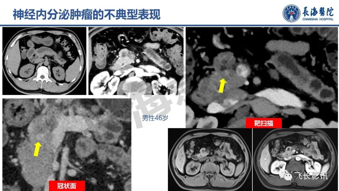 影像PPT - 【PPT】胰腺常见肿瘤的不典型影像表现—实战病例解析-26