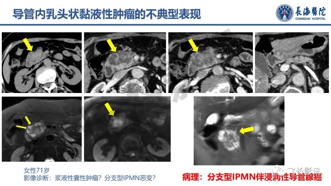 影像PPT - 【PPT】胰腺常见肿瘤的不典型影像表现—实战病例解析-31