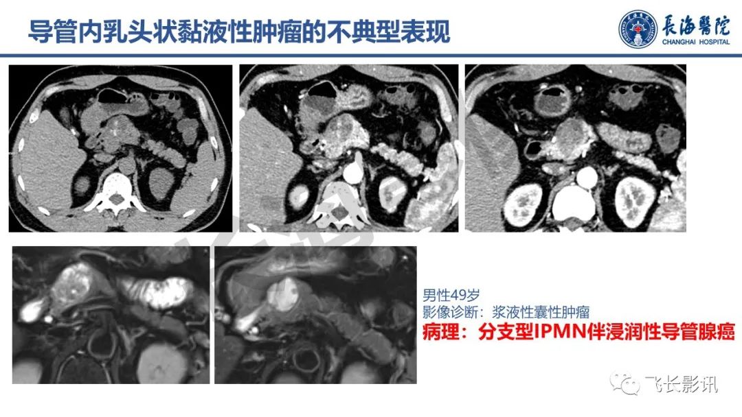 影像PPT - 【PPT】胰腺常见肿瘤的不典型影像表现—实战病例解析-30