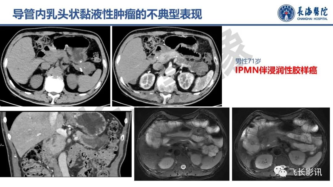影像PPT - 【PPT】胰腺常见肿瘤的不典型影像表现—实战病例解析-33