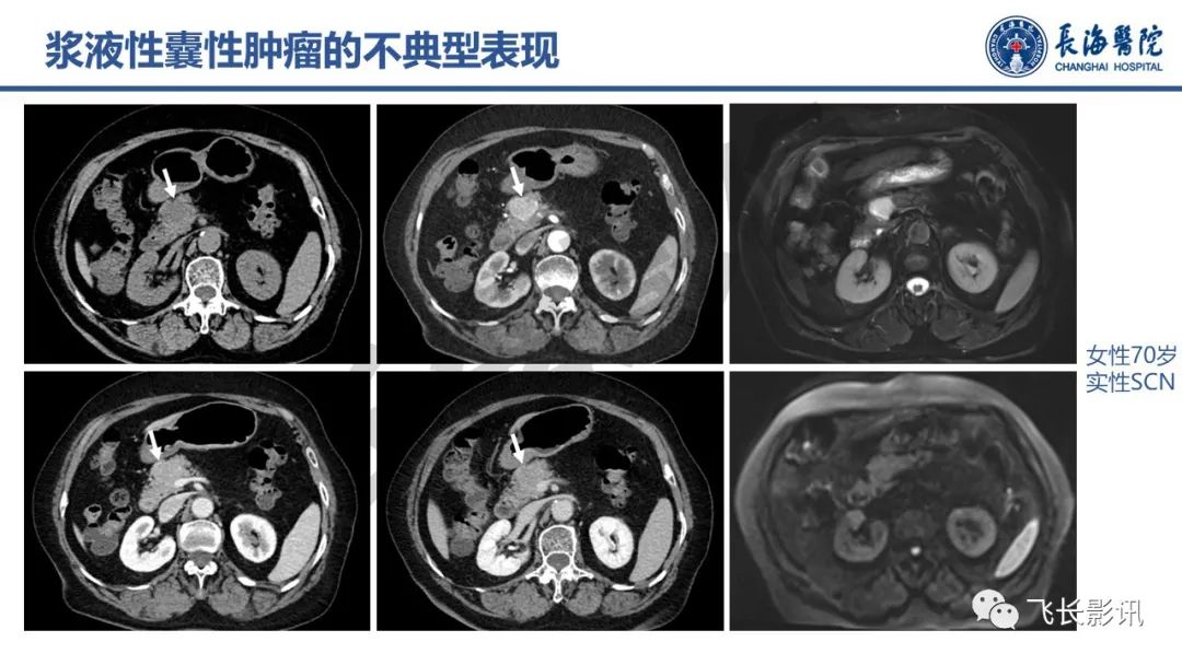 影像PPT - 【PPT】胰腺常见肿瘤的不典型影像表现—实战病例解析-35