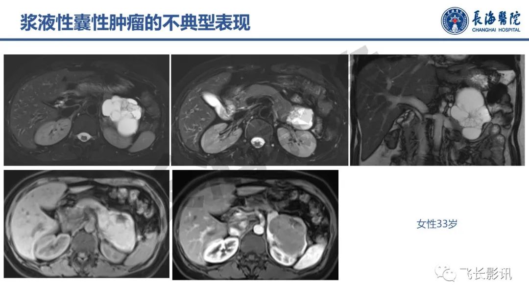 影像PPT - 【PPT】胰腺常见肿瘤的不典型影像表现—实战病例解析-37