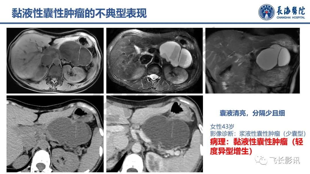 影像PPT - 【PPT】胰腺常见肿瘤的不典型影像表现—实战病例解析-41