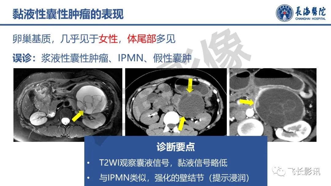 影像PPT - 【PPT】胰腺常见肿瘤的不典型影像表现—实战病例解析-42