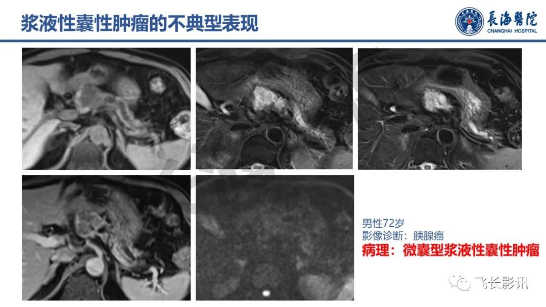 影像PPT - 【PPT】胰腺常见肿瘤的不典型影像表现—实战病例解析-39