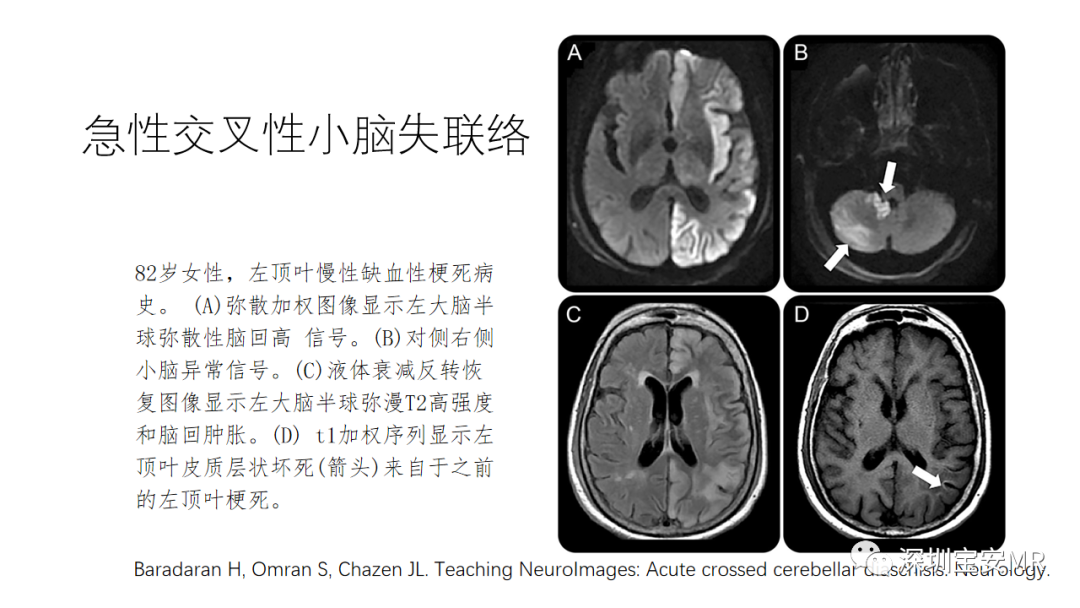 影像PPT - 【PPT】交叉性小脑失联络-6