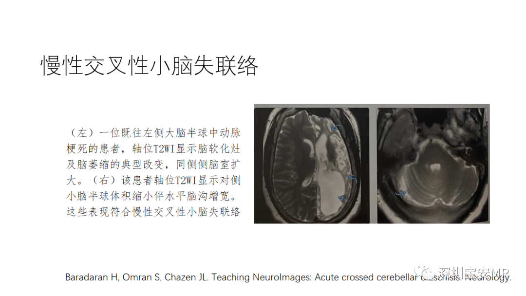 影像PPT - 【PPT】交叉性小脑失联络-8