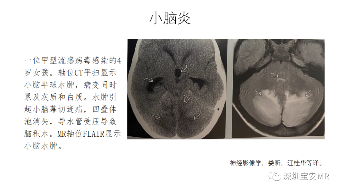 影像PPT - 【PPT】交叉性小脑失联络-11
