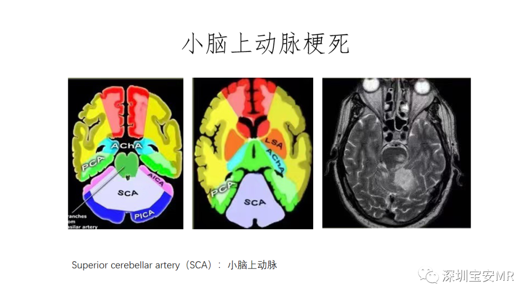 影像PPT - 【PPT】交叉性小脑失联络-10