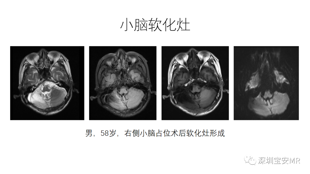影像PPT - 【PPT】交叉性小脑失联络-12
