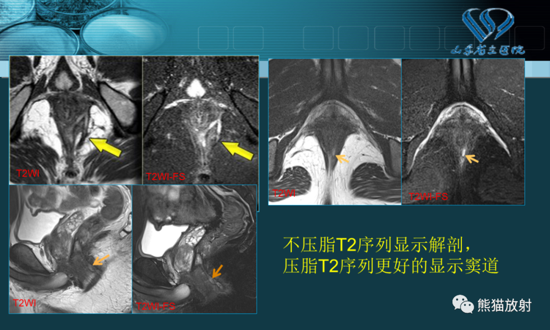 影像PPT - 【PPT】盆底解剖与肛周病变的MRI表现-7
