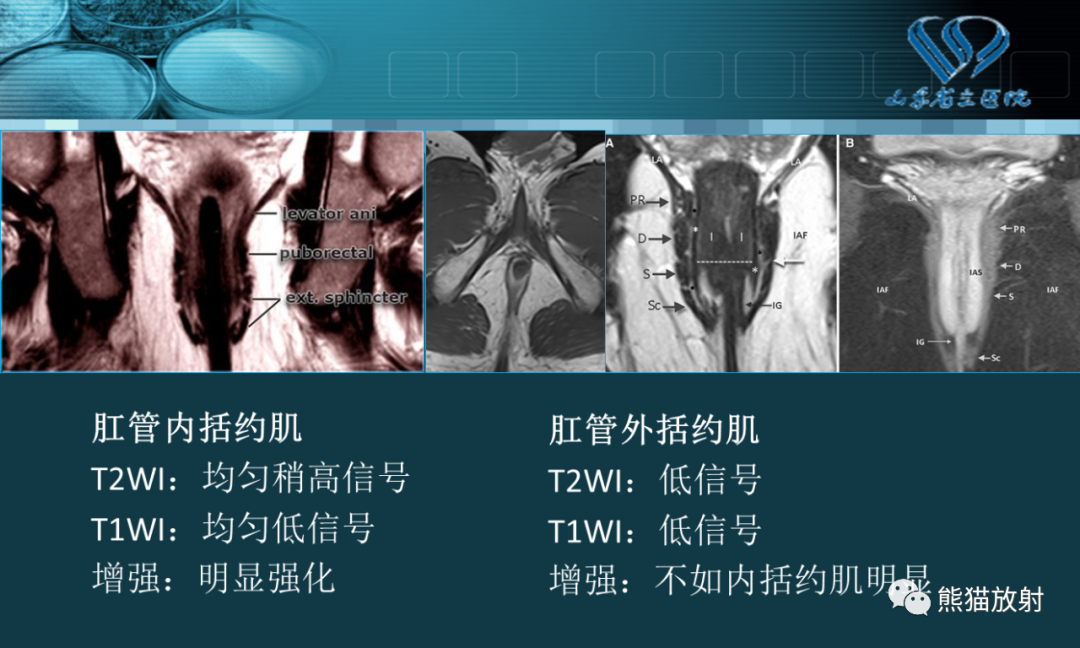影像PPT - 【PPT】盆底解剖与肛周病变的MRI表现-8
