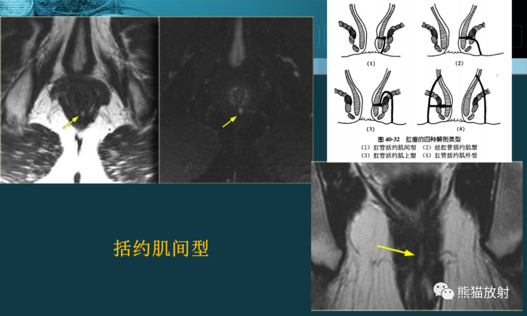 影像PPT - 【PPT】盆底解剖与肛周病变的MRI表现-15