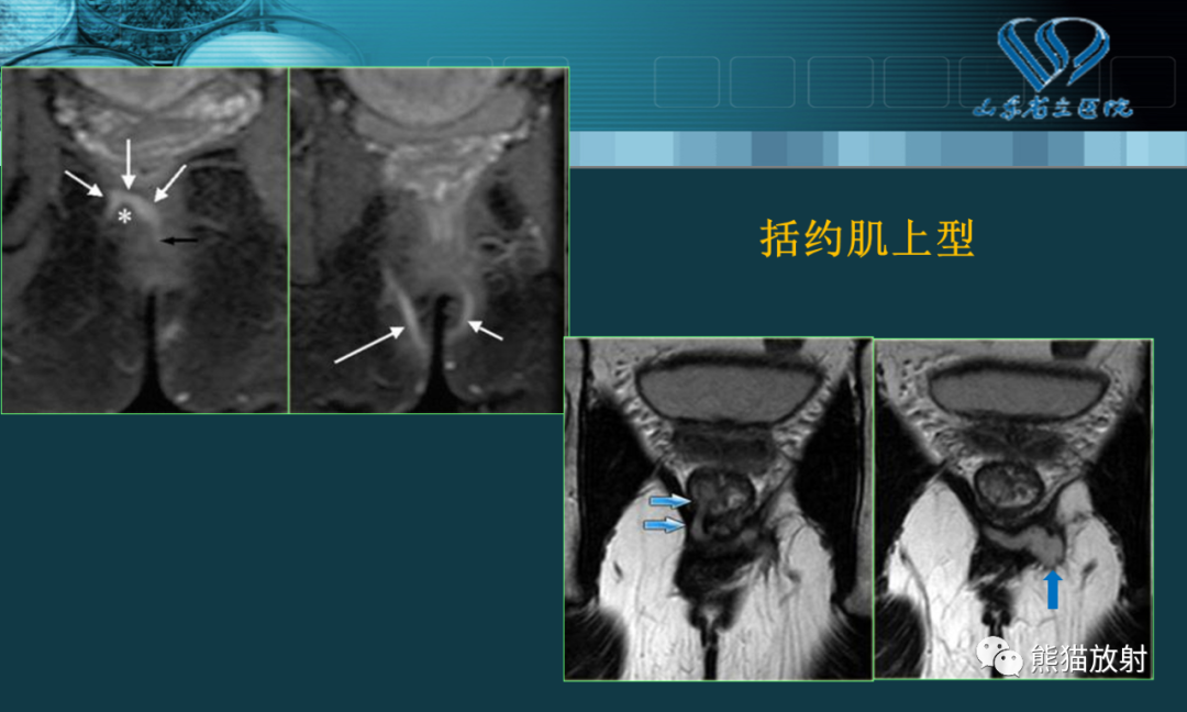 影像PPT - 【PPT】盆底解剖与肛周病变的MRI表现-17