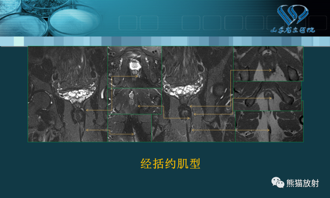 影像PPT - 【PPT】盆底解剖与肛周病变的MRI表现-18