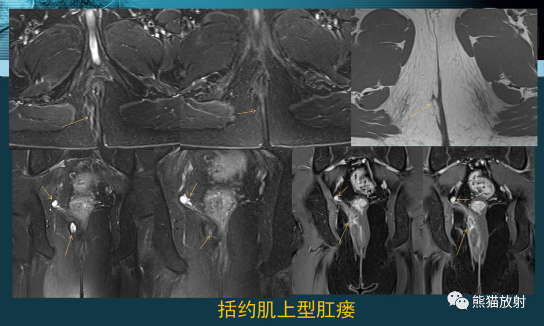 影像PPT - 【PPT】盆底解剖与肛周病变的MRI表现-21