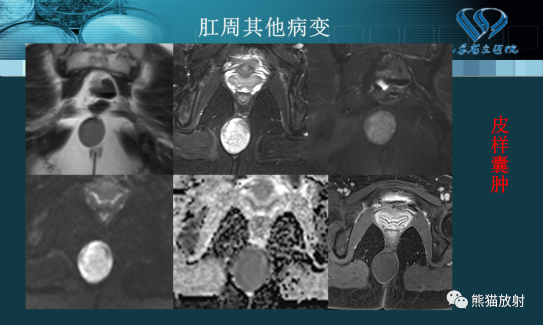 影像PPT - 【PPT】盆底解剖与肛周病变的MRI表现-27
