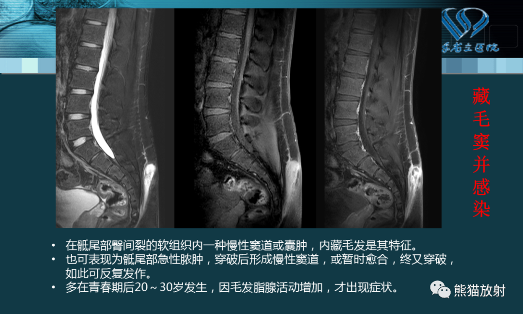 影像PPT - 【PPT】盆底解剖与肛周病变的MRI表现-30