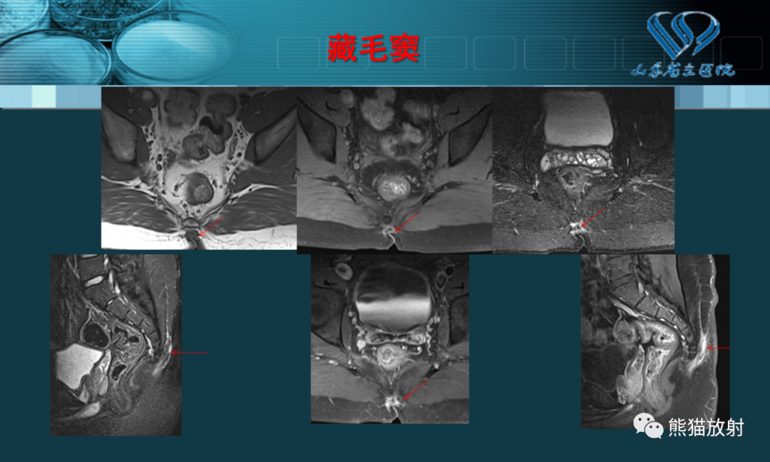 影像PPT - 【PPT】盆底解剖与肛周病变的MRI表现-31