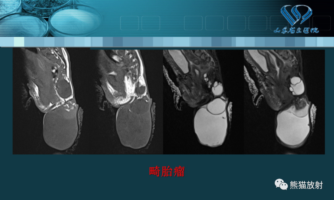 影像PPT - 【PPT】盆底解剖与肛周病变的MRI表现-29