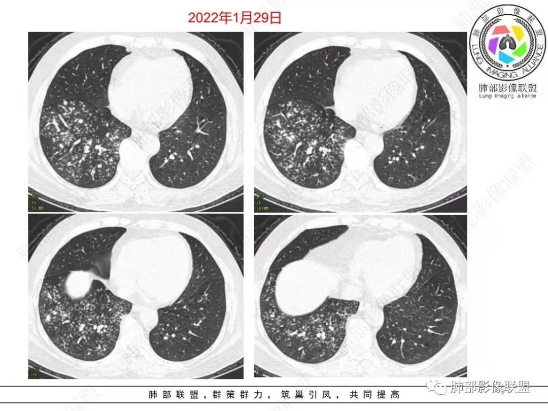影像PPT - 【病例】糖尿病+多发结节、树芽影，你如何诊断？-9