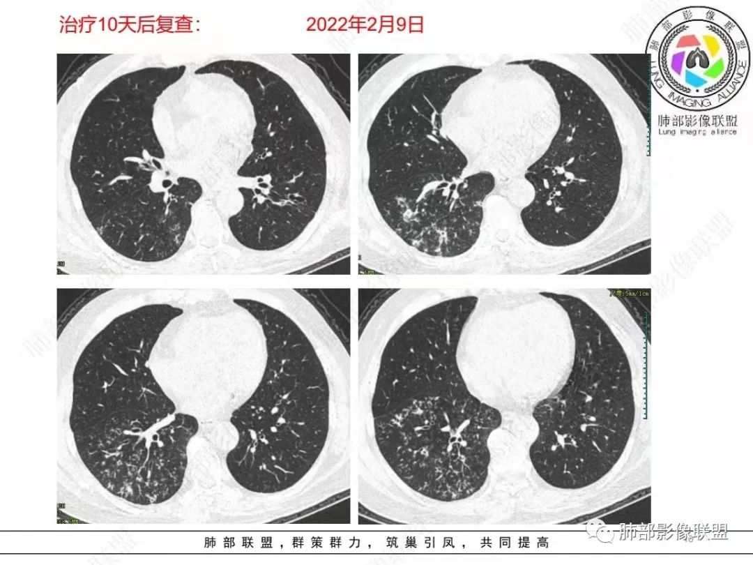影像PPT - 【病例】糖尿病+多发结节、树芽影，你如何诊断？-10