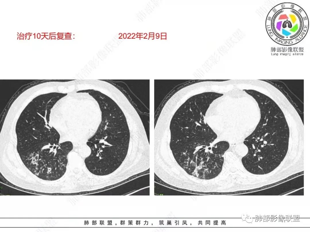 影像PPT - 【病例】糖尿病+多发结节、树芽影，你如何诊断？-11