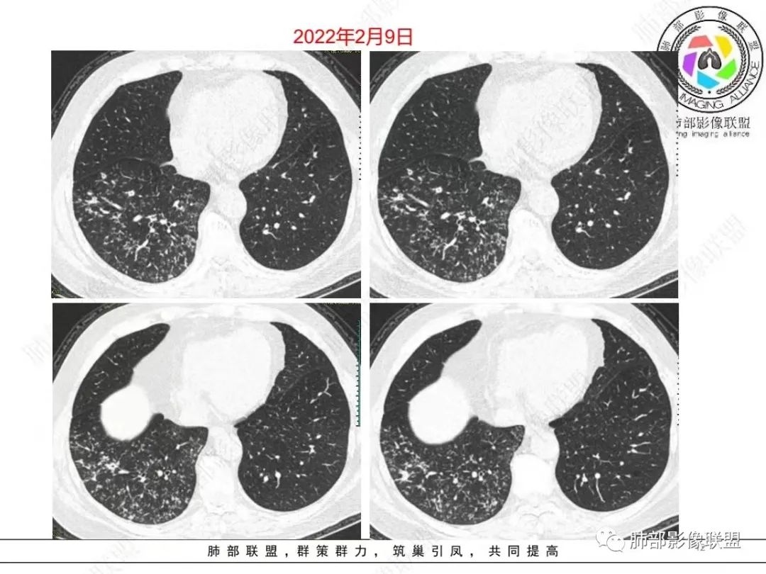 影像PPT - 【病例】糖尿病+多发结节、树芽影，你如何诊断？-12