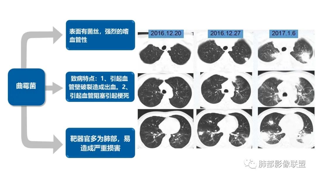 影像PPT - 【病例】糖尿病+多发结节、树芽影，你如何诊断？-27