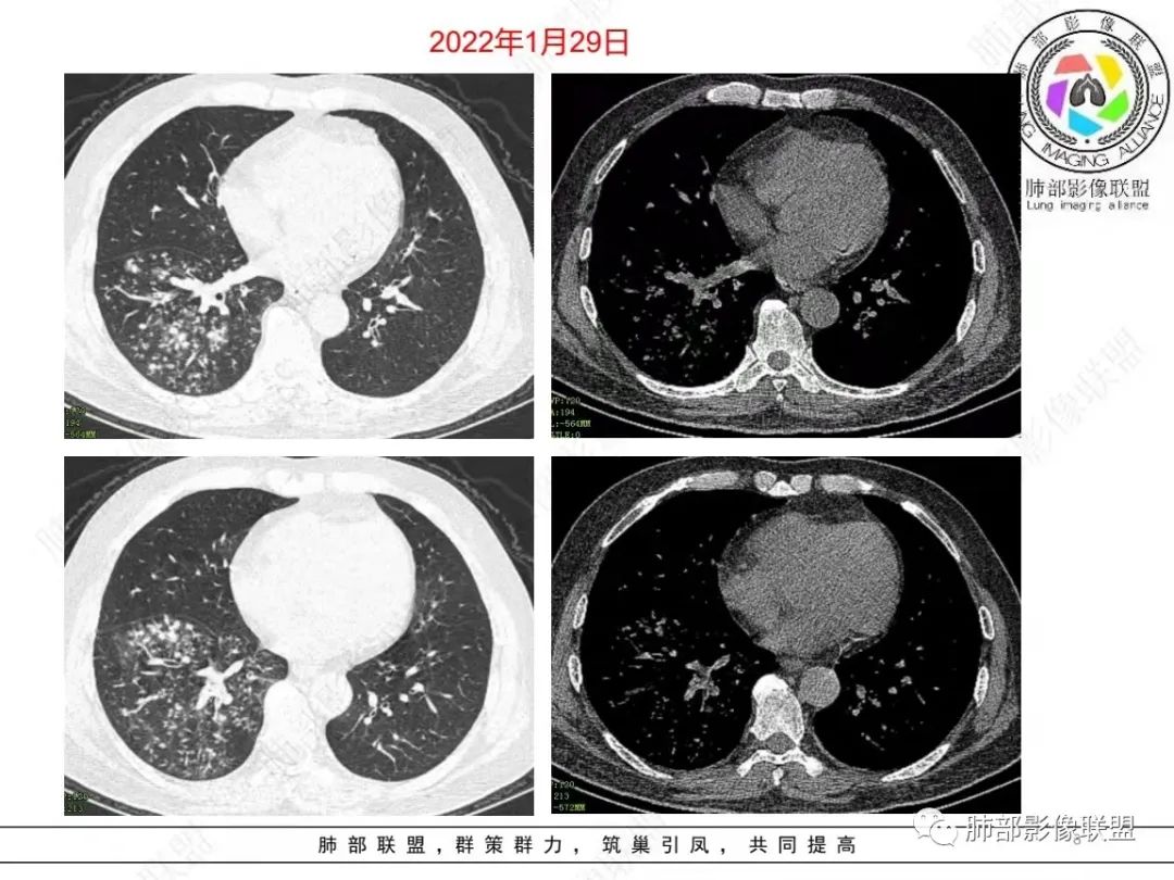 影像PPT - 【病例】糖尿病+多发结节、树芽影，你如何诊断？-8