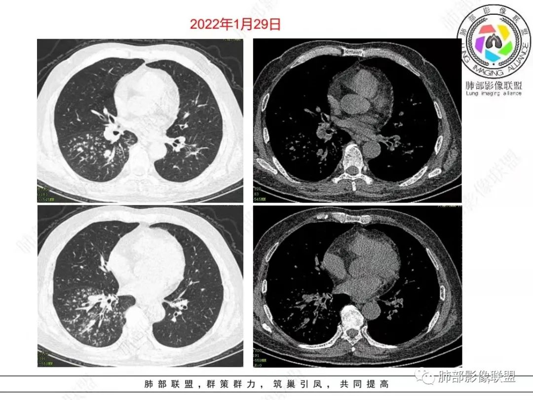 影像PPT - 【病例】糖尿病+多发结节、树芽影，你如何诊断？-3