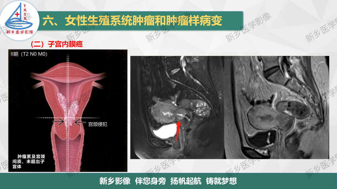 影像PPT - 【PPT】子宫内膜癌分期的影像表现-8