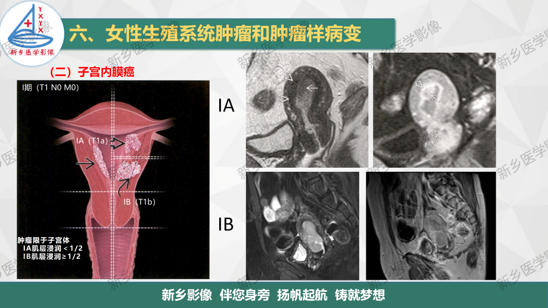影像PPT - 【PPT】子宫内膜癌分期的影像表现-6